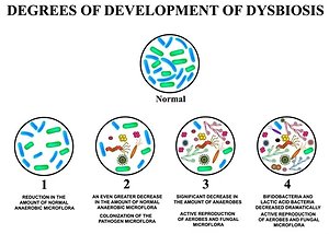 The Microbiome, Dysbiosis & Leaky Gut. stagesdysbiosis